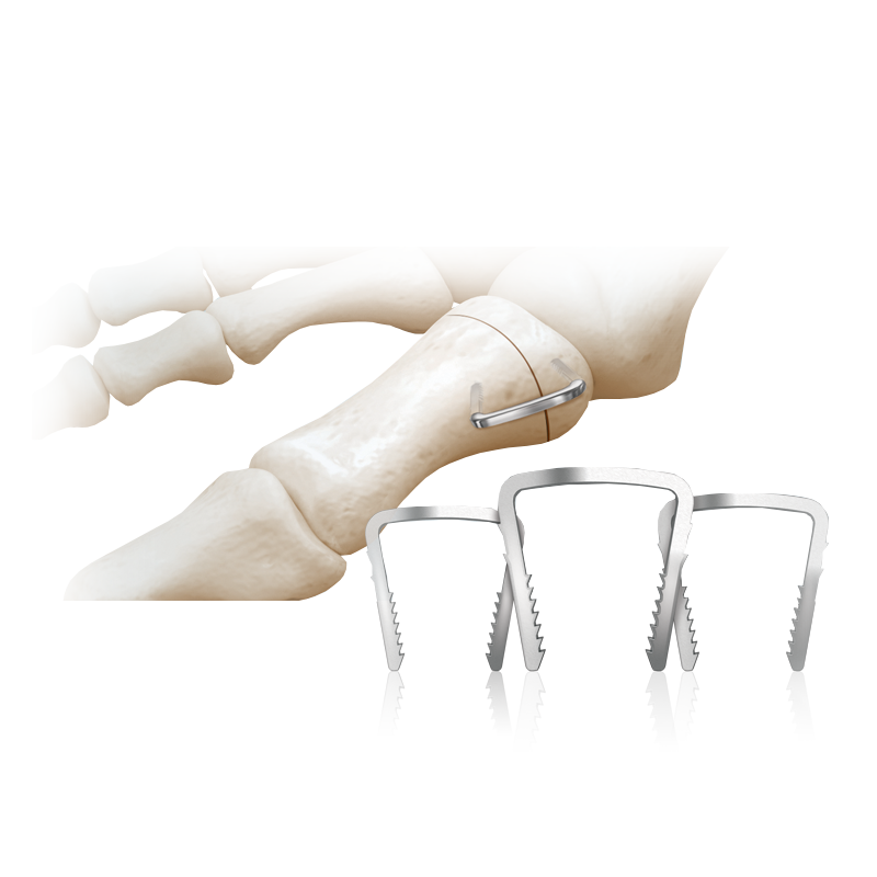 NeoSpan<sup>®</sup> SE Compression Staples
