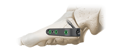 5ms pseudo jones hook plate in the bone