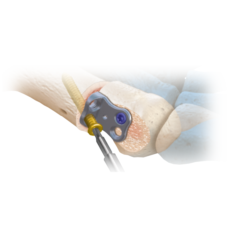 CoLink<sup>®</sup> Vallux Active Bunion Plating System