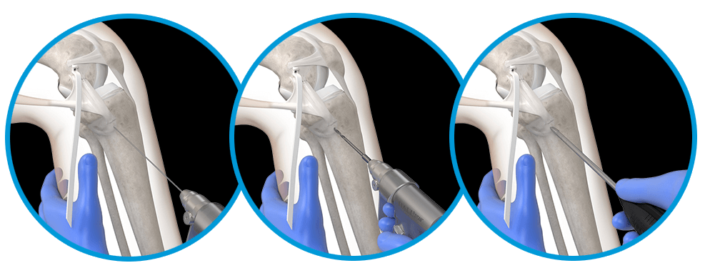 Repair the ligament with the preloaded suture, then prepare the tibial pilot hole