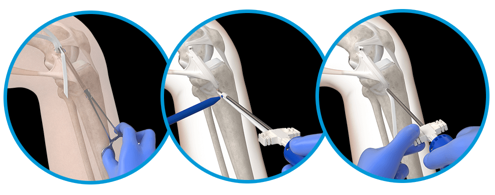 Shuttle the implant distally, tension to match native tissue, deploy second anchor, trim excess, and close