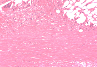 image of biobrace filled with new tissue