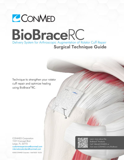 BioBraceRC Surgical Technique Guide
