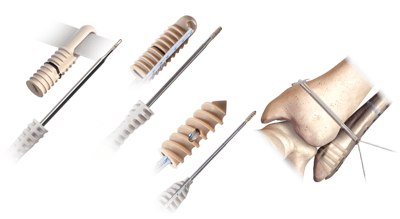 Hercules Product Collection FT Fully Threaded, FT Knotless, Knotless Syndesmosis System, and XE