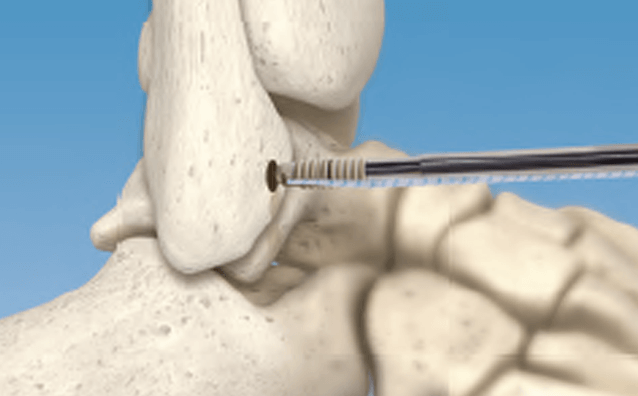 Soft Tissue Repair Using the Hercules Fully Threaded Suture Anchor and the Hercules Knotless Suture Anchor